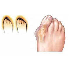 Bone Ectropion Corrector Bunion Toes